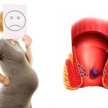 Геморрой при беременности и после родов - способы лечения